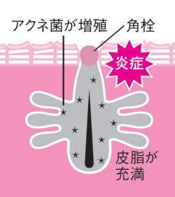 ニキビと角質